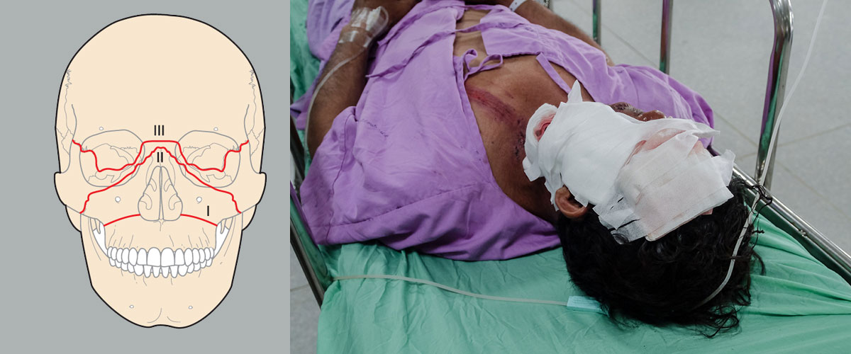 Facial Injuries Facial Bone Fracture Dr Mathan Mohan