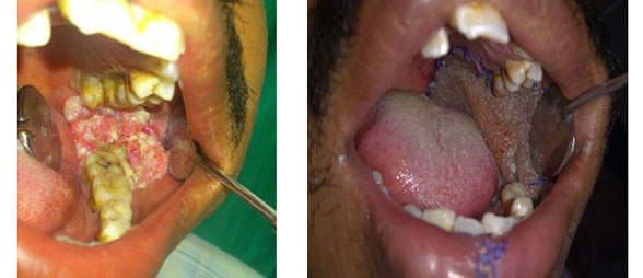 Oral Cancer Surgeries and Reconstruction