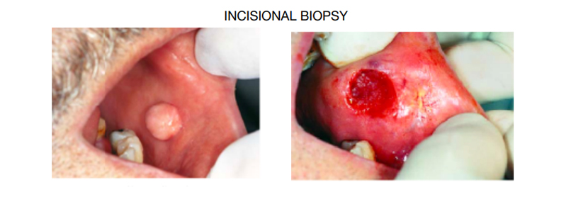 BIOPSY - INCISIONAL / EXCISIONAL