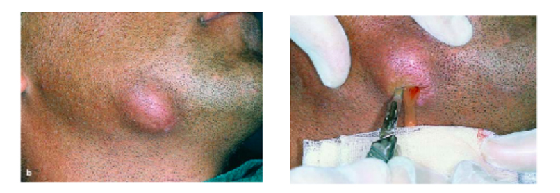 INCISION AND DRAINAGE - FACIAL SPACE INFECTIONS