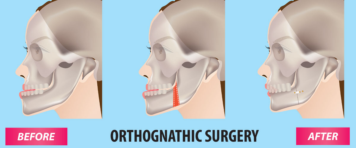 Orthognathic Surgeries (Cosmetic Jaw Surgery)