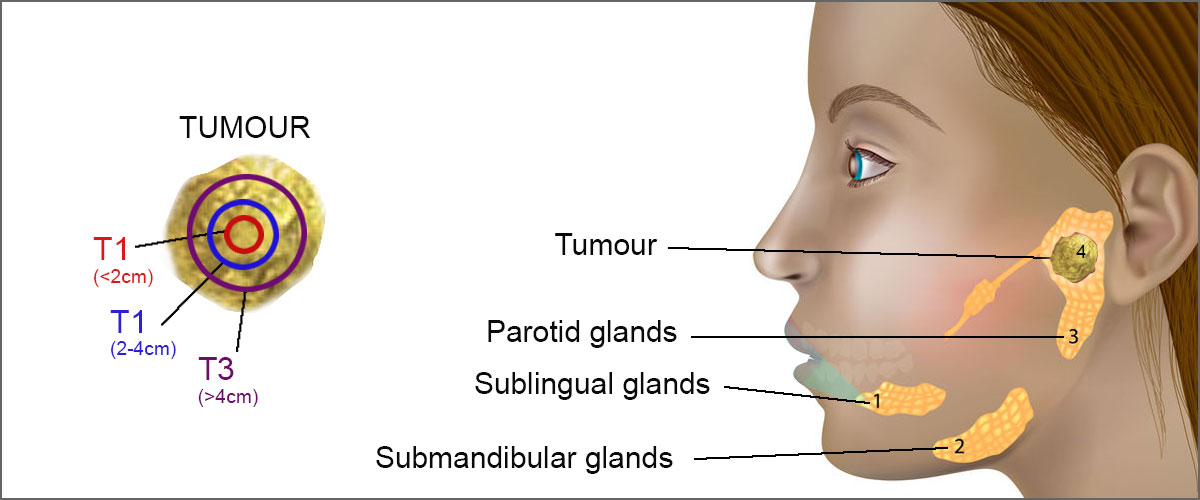 Salivary gland tumours
