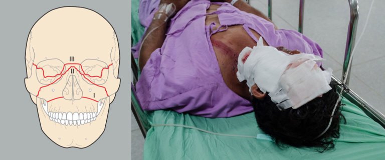 Facial Injuries / Facial Bone Fracture - Dr. Mathan Mohan